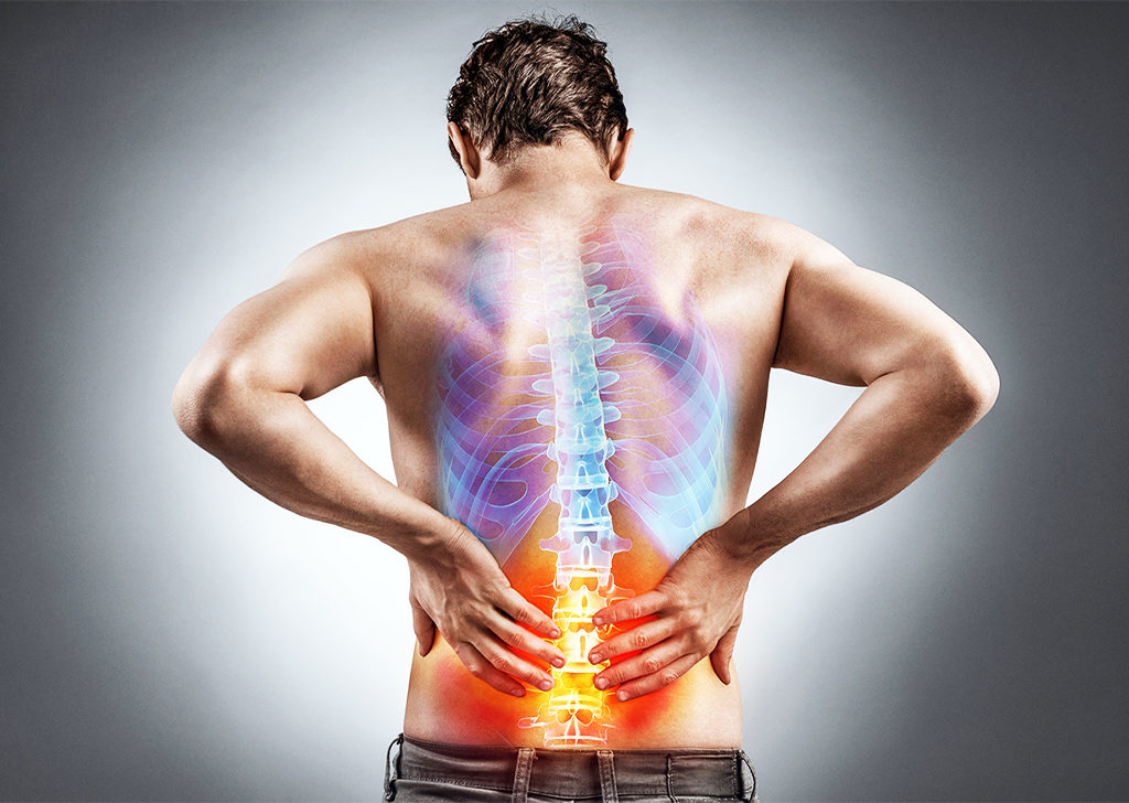 Радикулит как причина боли в спине